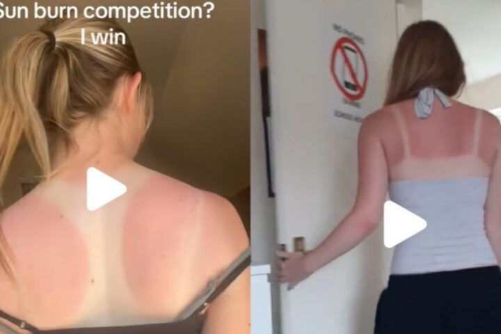 Sunburn Challenge